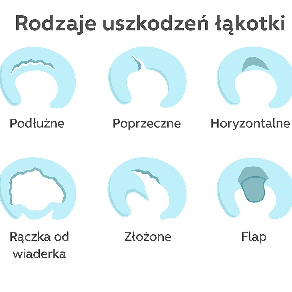 uszkodzenie-kotki-objawy-leczenie-wiczenia-neuroport